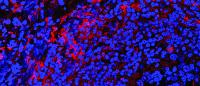 Cancerous colorectal tissue infected with F. Nucleatum